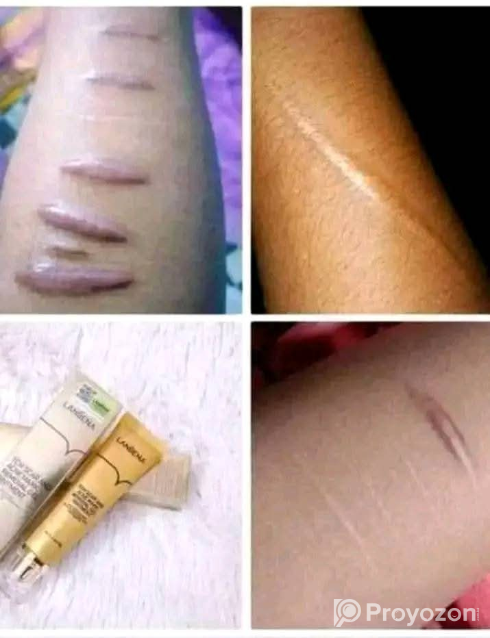 মাত্র একটি জেল কাঁটা পোড়া দাগ দূর করবে