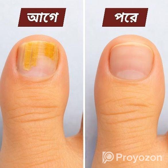নখের যেকোনো ধরনের সমস্যা দূর করে। ঔষধ